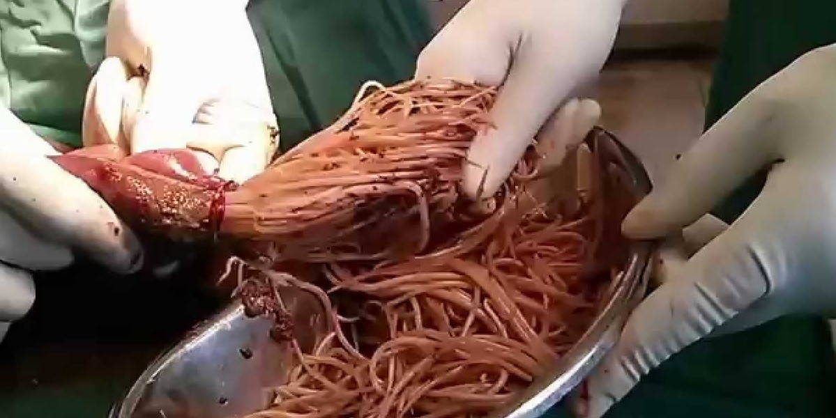 FAKE: Undigested Noodles Operated from Intestine